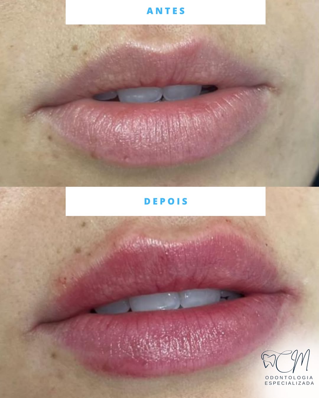 Preenchimento Labial — antes e depois
